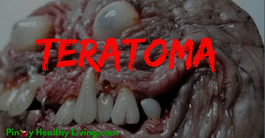 Teratoma: Cancerous Tumor o Halimaw?